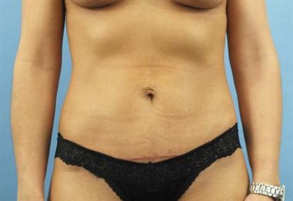 Tummy Tuck Before & After Patient #265