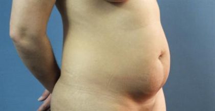 Liposuction Before & After Patient #279