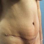 Liposuction Before & After Patient #279