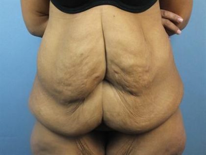 Body Contouring Before & After Patient #287
