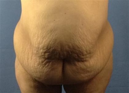 Tummy Tuck Before & After Patient #295