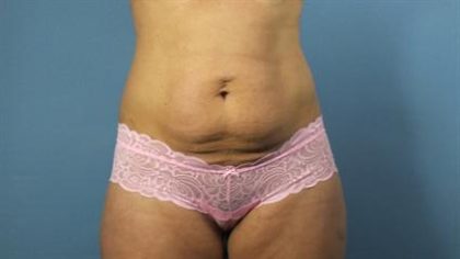 Tummy Tuck Before & After Patient #298