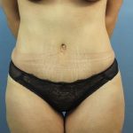 Liposuction Before & After Patient #304