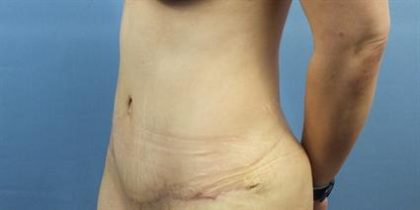 Liposuction Before & After Patient #304