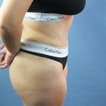 Liposuction Before & After Patient #315