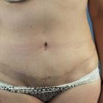 Liposuction Before & After Patient #321