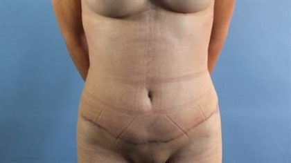 Tummy Tuck Before & After Patient #330