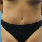 Tummy Tuck Before & After Patient #336