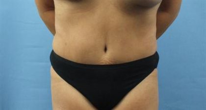 Tummy Tuck Before & After Patient #336