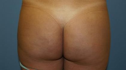 Brazilian Butt Lift Before & After Patient #382