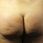 Brazilian Butt Lift Before & After Patient #382