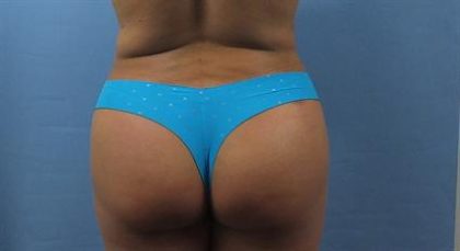 Brazilian Butt Lift Before & After Patient #385