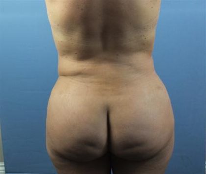 Brazilian Butt Lift Before & After Patient #388