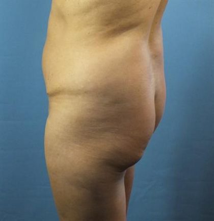 Brazilian Butt Lift Before & After Patient #391