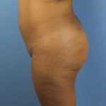 Brazilian Butt Lift Before & After Patient #391