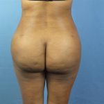 Brazilian Butt Lift Before & After Patient #395