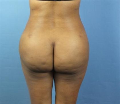 Brazilian Butt Lift Before & After Patient #395