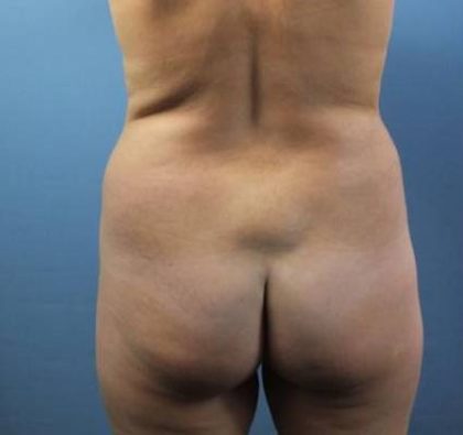 Brazilian Butt Lift Before & After Patient #398