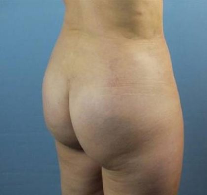 Brazilian Butt Lift Before & After Patient #398