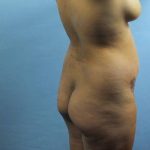 Brazilian Butt Lift Before & After Patient #403