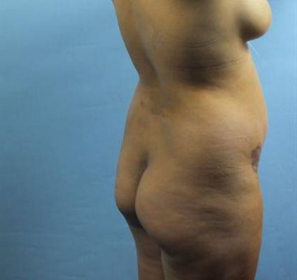 Brazilian Butt Lift Before & After Patient #403
