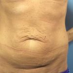 Tummy Tuck Before & After Patient #318