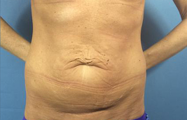 Tummy Tuck Before & After Patient #318