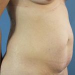 Tummy Tuck Before & After Patient #324