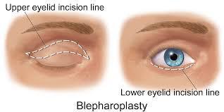 blepharoplasty fairfield