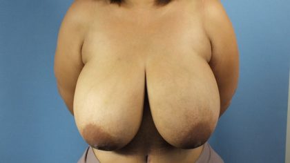 Breast Reduction Before & After Patient #1746