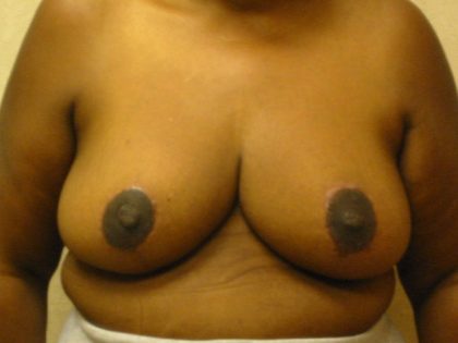 Breast Reduction Before & After Patient #1769