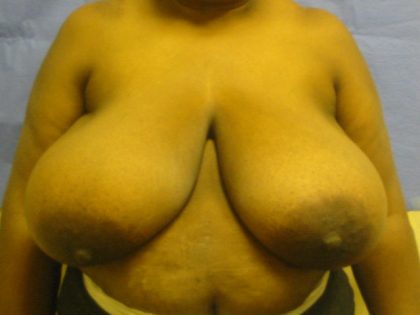 Breast Reduction Before & After Patient #1769