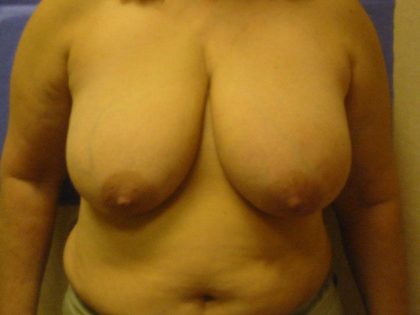 Breast Reduction Before & After Patient #1770