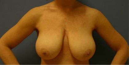Breast Reduction Before & After Patient #1771