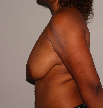 Breast Reduction Before & After Patient #1818